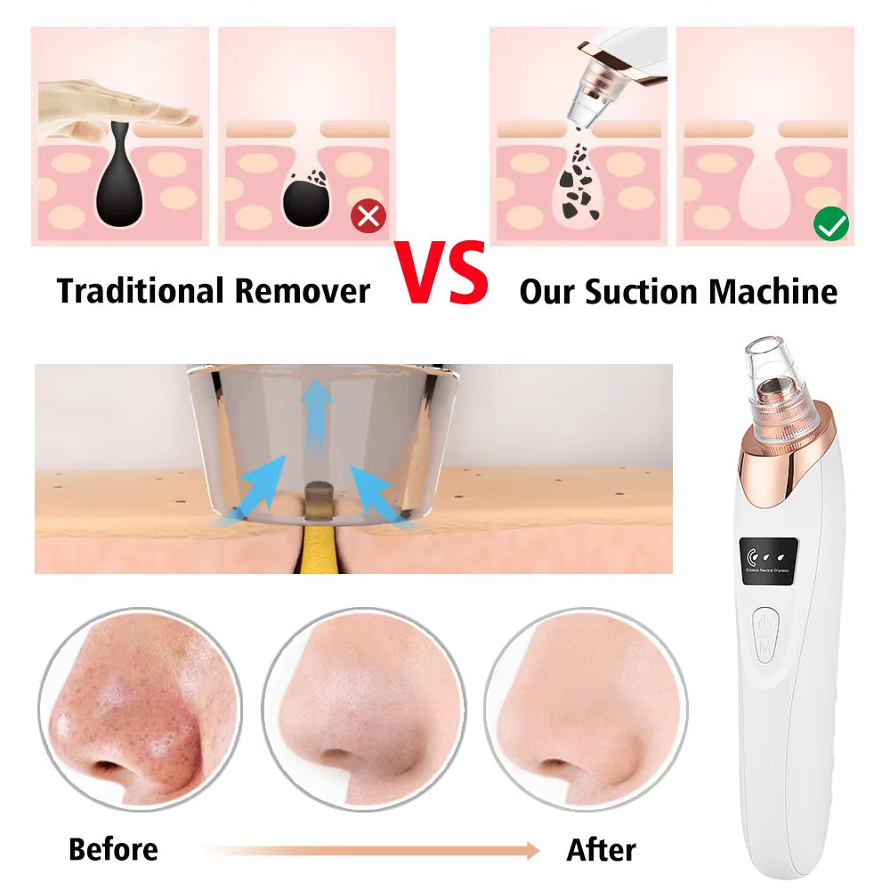 Electric Vacuum Blackhead Remover - White - 3 Suction Levels, 5 Heads, USB Rechargeable, Portable Skin Cleaner