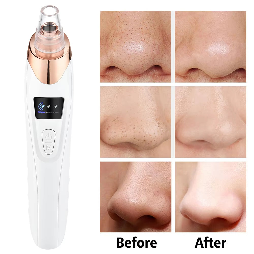 Electric Vacuum Blackhead Remover - White - 3 Suction Levels, 5 Heads, USB Rechargeable, Portable Skin Cleaner